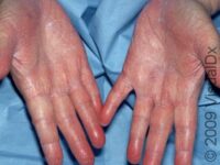 Dry Skin (Xerosis)