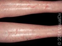 Dry Skin (Xerosis)