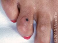 Mole (Nevus)