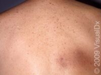 Notalgia Paraesthetica