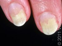 Nail Lifting (Onycholysis) – Adult