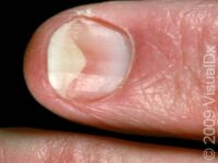 Nail Lifting (Onycholysis)