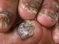Nail Infection, Fungal (Onychomycosis)