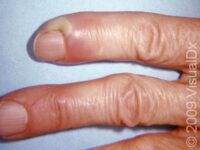 Nail Infection (Paronychia) – Adult