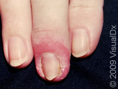 This image displays cracks and swelling around the nail, typical of chronic paronychia.