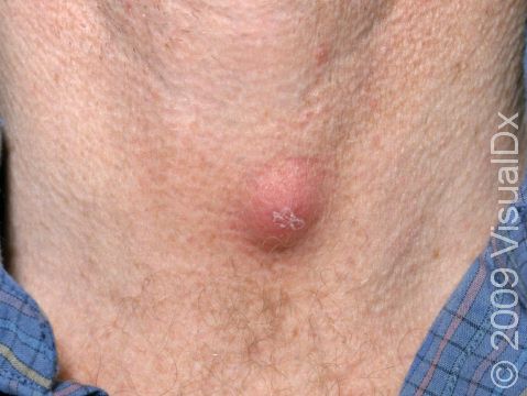 Do You Need a Cyst Removed? Here’s What to Know