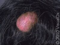 Pilar Cyst