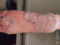 Plantar Wart