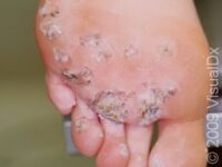 Plantar Wart
