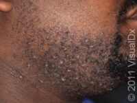 Razor Bumps (Pseudofolliculitis Barbae) – Adult