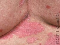 Psoriasis