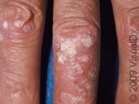 Psoriasis