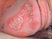 Psoriasis