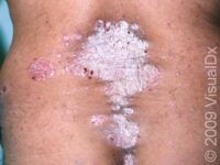 Psoriasis