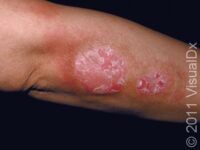 Plaque Psoriasis – Adult