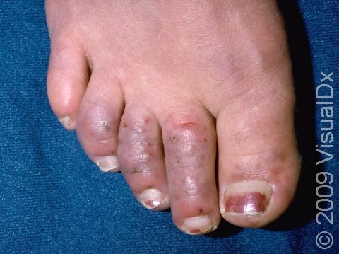 Typical to Raynaud disease, this image displays purple toes due to constricted blood vessels.