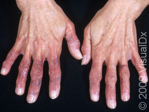 This image displays fingers that are purple and chronically cold due to Raynaud disease.