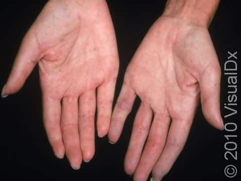 This image displays the hands of a person with scleroderma and a severe case of Raynaud disease.