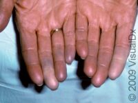 Raynaud’s Phenomenon