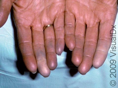 This image displays the blue color of the fingers typical of Raynaud disease due to the constriction of blood vessels.