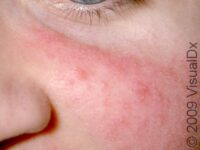 Rosacea