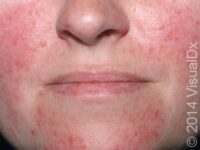 Rosacea