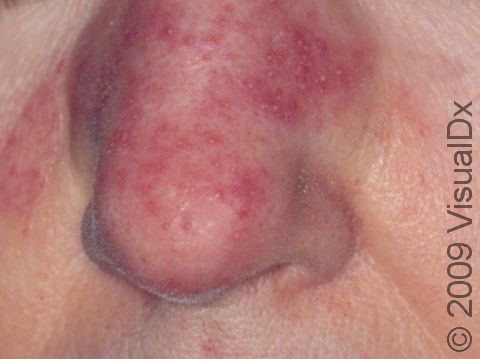 Rosacea is often characterized by small pimple-like pus-filled lesions (pustules) and red bumps.