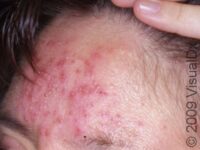 Rosacea