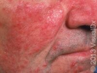 Rosacea – Adult