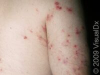 Scabies