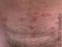 Scabies