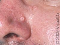 Sebaceous Hyperplasia