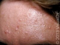 Sebaceous Hyperplasia – Adult