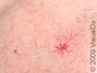 Spider Angioma