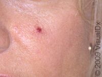 Spider Angioma