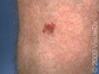 Squamous Cell Carcinoma (SCC)