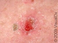 Squamous Cell Carcinoma (SCC)