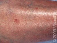 Squamous Cell Carcinoma (SCC)