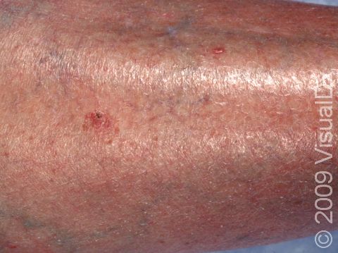 Squamous cell carcinoma can appear as a persistent, red, scaly lesion easily mistaken for an area of inflamed skin (dermatitis).