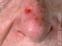 Squamous Cell Carcinoma (SCC)