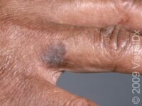 Squamous Cell Carcinoma (SCC)