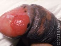 Squamous Cell Carcinoma (SCC)