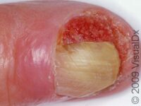 Squamous Cell Carcinoma (SCC)