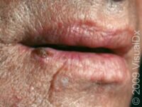 Squamous Cell Carcinoma (SCC)