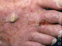 Squamous Cell Carcinoma (SCC)