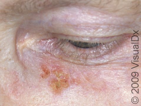 A squamous cell carcinoma is often hard to distinguish from an actinic keratosis, which is its precursor.