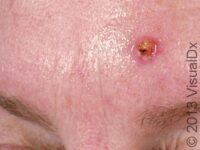 Squamous Cell Carcinoma (SCC)