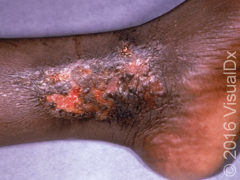 This image displays foot and ankle swelling and inflammation typical of stasis ulcers.