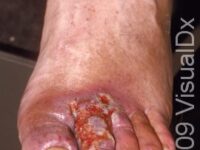Stasis Ulcer