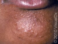Syringoma